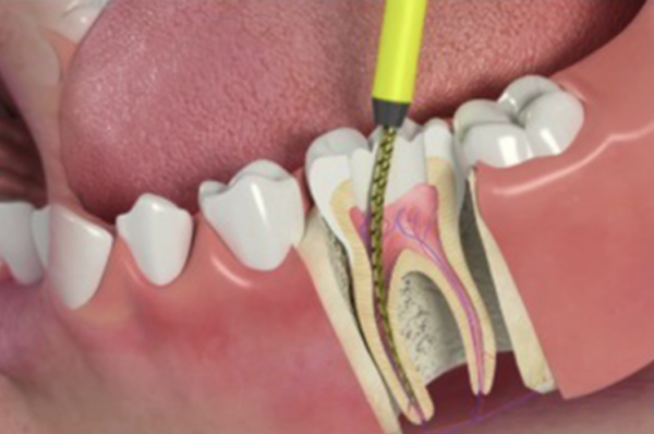 dental abscess treatment