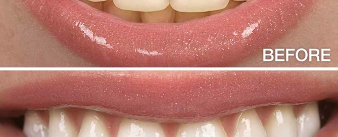 whitened teeth tips