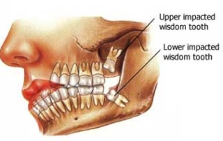wisdom teeth extraction
