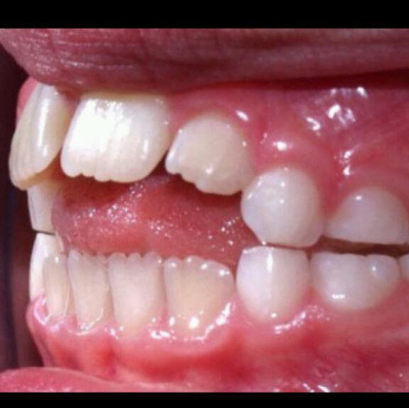 pacifier misaligned teeth