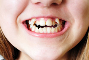 misaligned teeth from pacifier