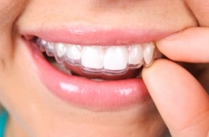 woman holding invisalign to teeth