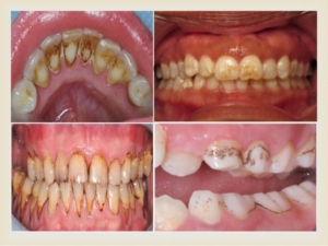 Teeth discoloration