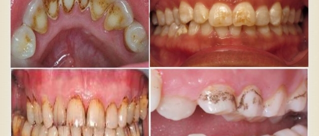 Teeth discoloration