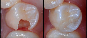 tooth filling before and after