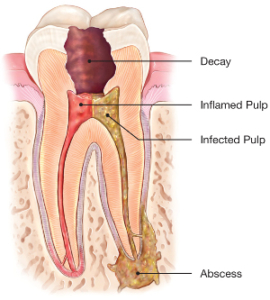 endodontics root canal treatment area