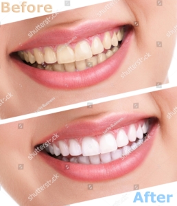 bleaching-teeth-treatment-close-up