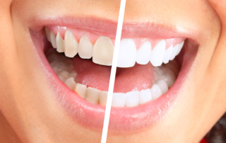 teeth whitening before and after