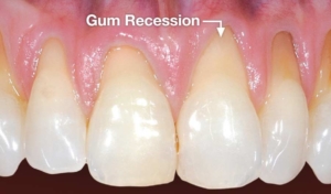 Receding Gum line