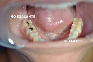 Why-Sealants
