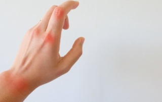 rheumatoid-arthritis