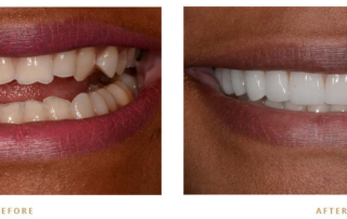Permanently whiten teeth monroe nc dentist