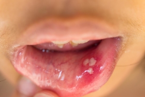 hpv throat and mouth cancer