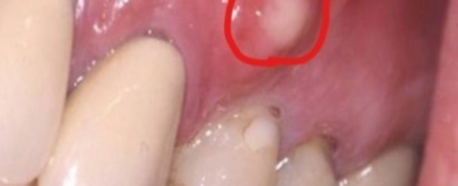 Abscess Tooth symptoms