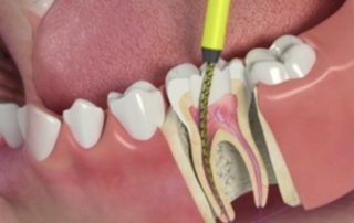 tooth abscess