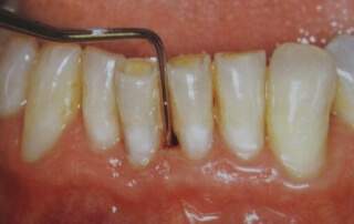 Periodontal-disease