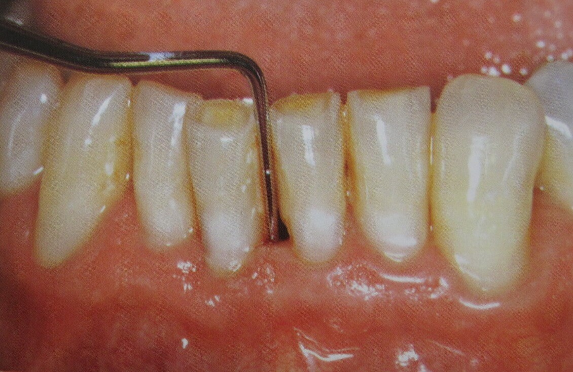 Long-Term Risks of Periodontal Disease | Monroe Family Dentist