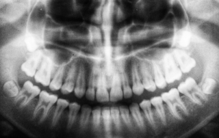 Root Canal Therapy