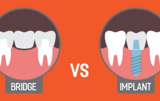 Dental Bridge Vs Implant | Monroe Family Dentistry