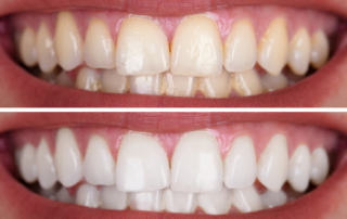 Teeth Whitening In Monroe NC