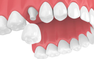 Dental Crowns - Monroe Family Dentistry
