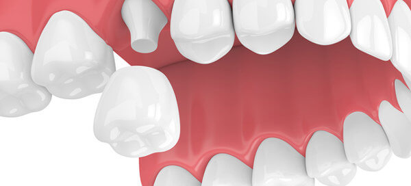 Dental Crowns - Monroe Family Dentistry