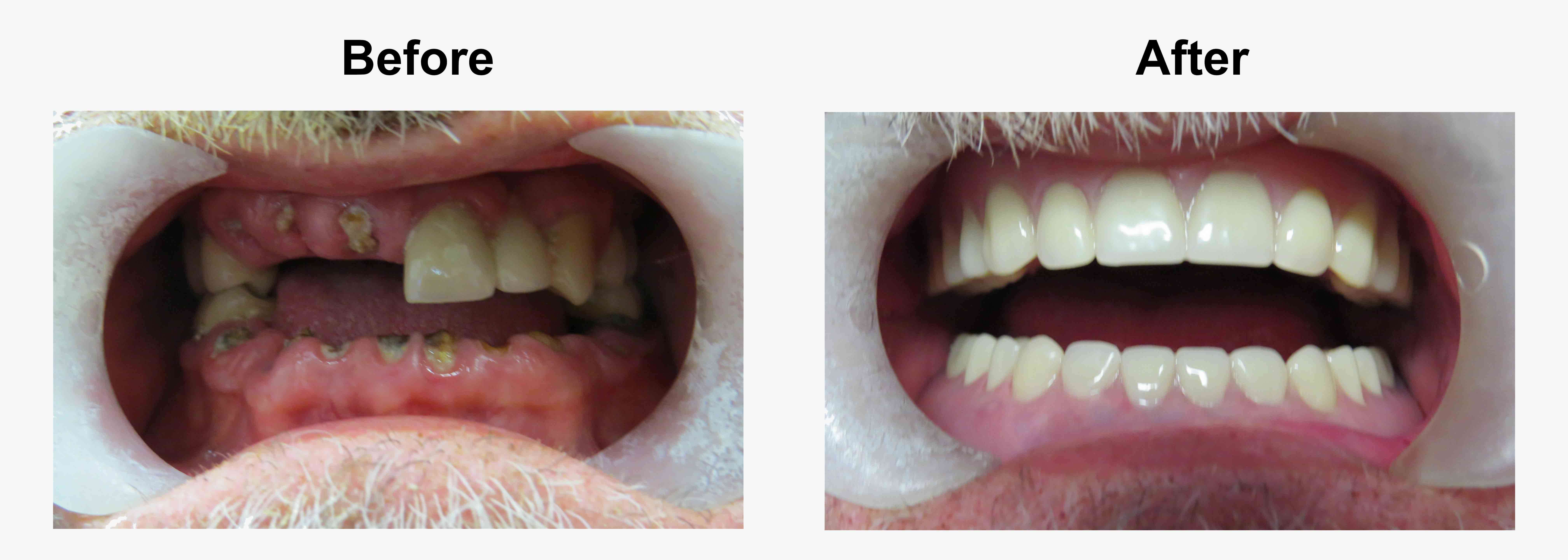 sample dentures