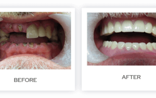 7 Misconceptions About Dentures
