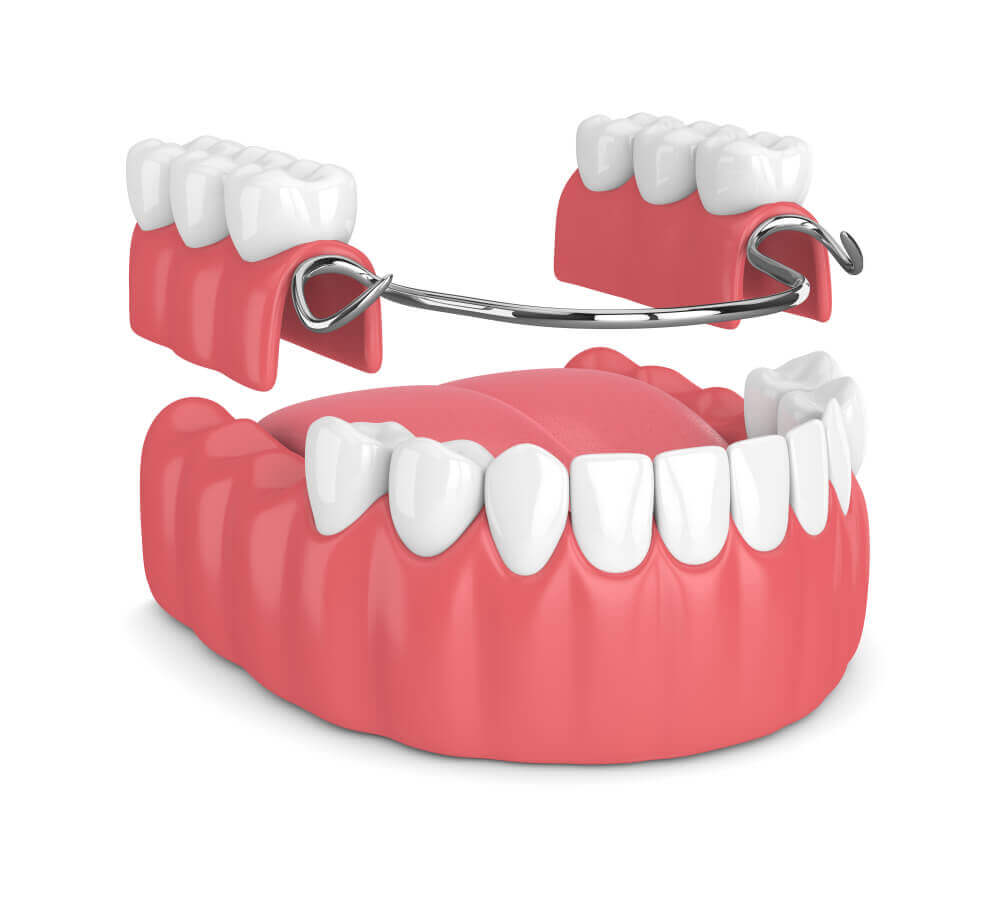 Complete & Partial Dentures