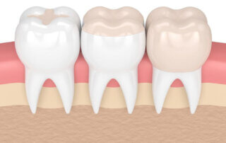 Facts About Inlays and Onlays - Monroe Family Dentistry