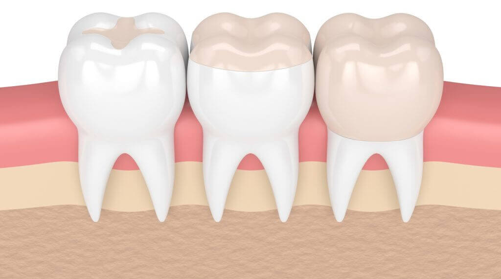 5 Facts About Inlays and Onlays | Monroe Family Dentistry