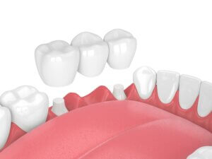 The Risk Of Getting A Dental Bridge - Monroe Family Dentistry