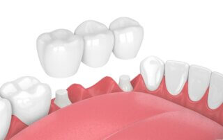 The Risk Of Getting A Dental Bridge - Monroe Family Dentistry