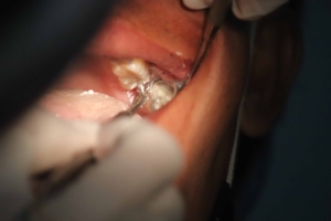 Differences Between Composite & Metal Fillings - Monroe Family Dentistry