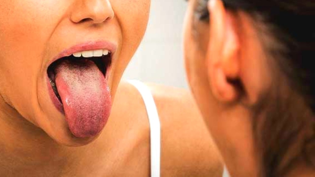 Oral Lichen Planus Explained Monroe Family Dentistry Monroe Family