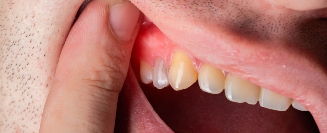 Can a Cold Cause Swollen Gums - Dentist In Monroe NC