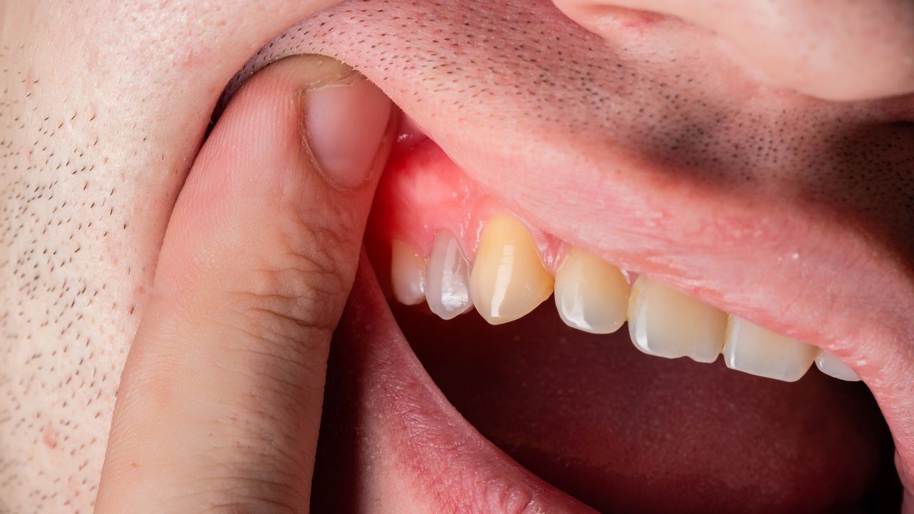 Can a Cold Cause Swollen Gums - Dentist In Monroe NC