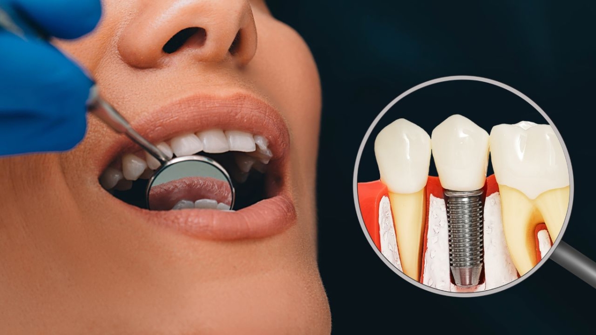 Dental Implants For Seniors Cost & Overview Dentist In Monroe