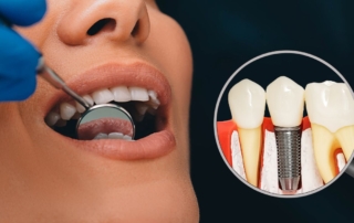 Dental Implants For Seniors Cost and Overview - Monroe Family Dentistry